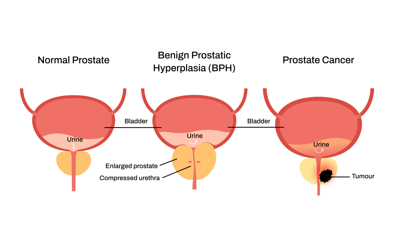 Can BPH Turn Into Cancer?