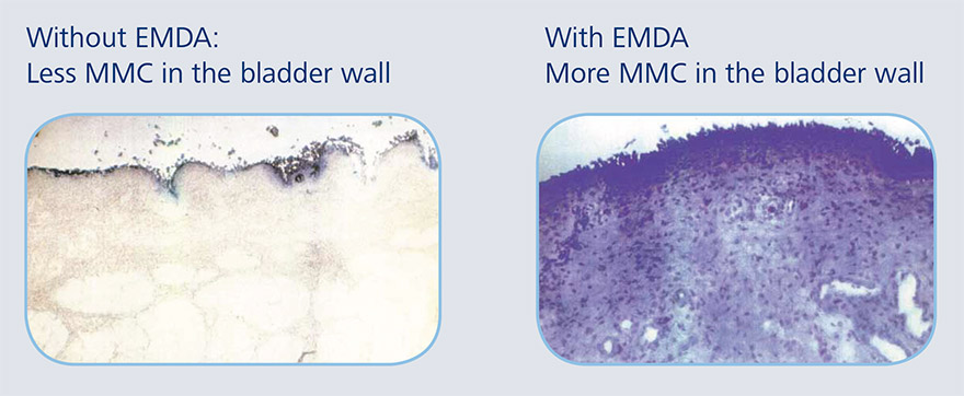 EMDA treatment for bladder cancer