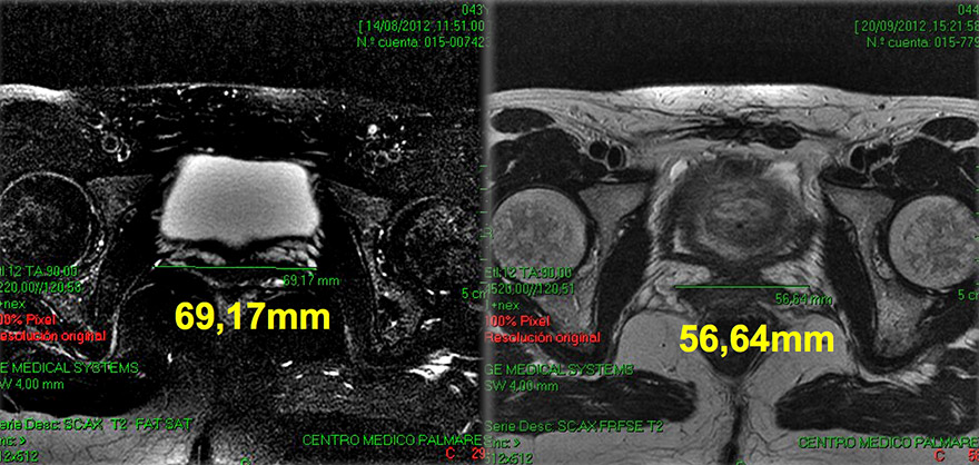 MRI scans: before Intimalase treatment (left); 1 month after (right)