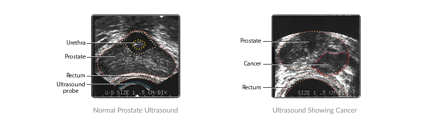 trus-biopsy