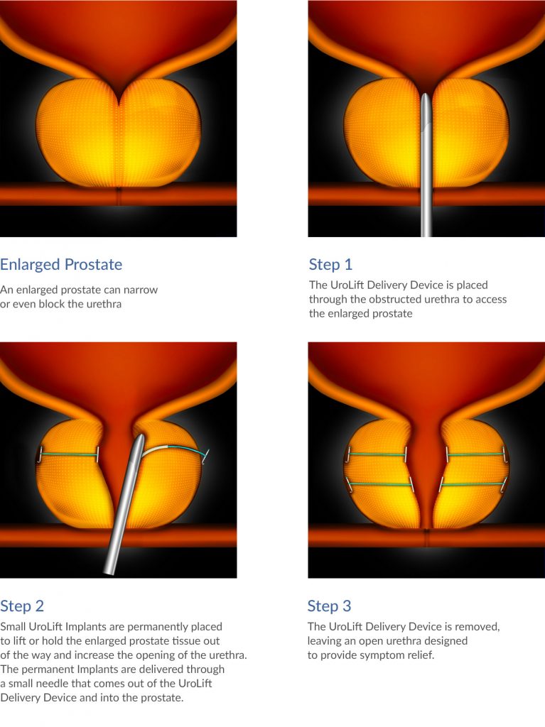 Urolift Enlarged Prostate Treatment