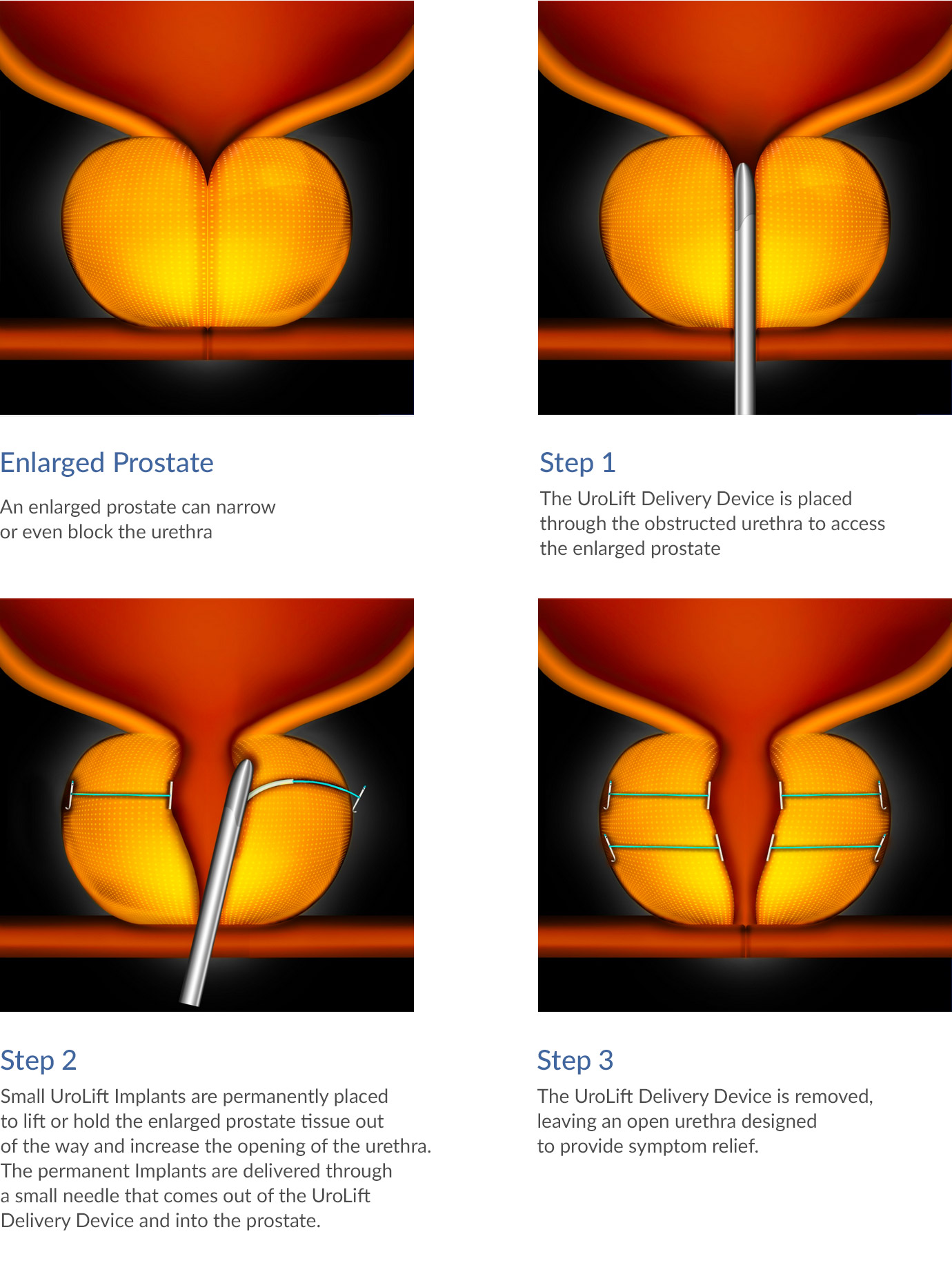 UroLift